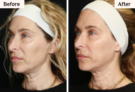 renuva facial filler before and after results